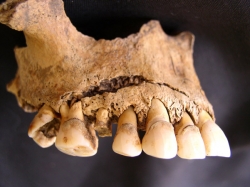 Blunt force injury on upper jaw